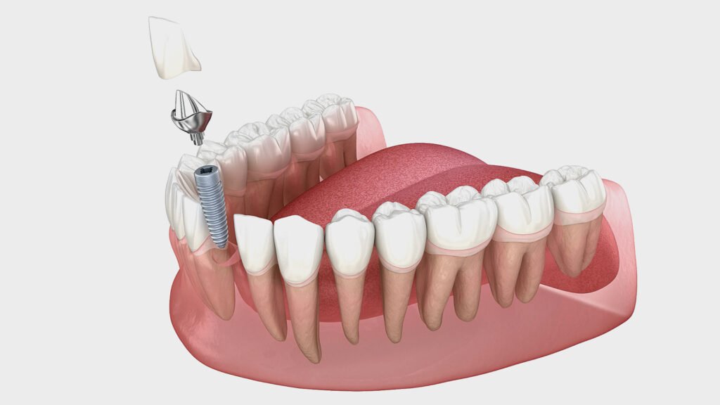 Dental Implants in Visalia